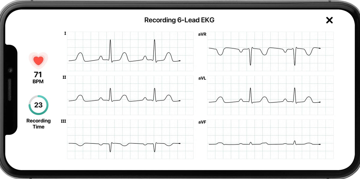 AliveCor KardiaMobile 6L Personal EKG Monitor, Black - KM-6L-E
